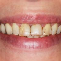 Porcelain Veneers - Smile 2 before